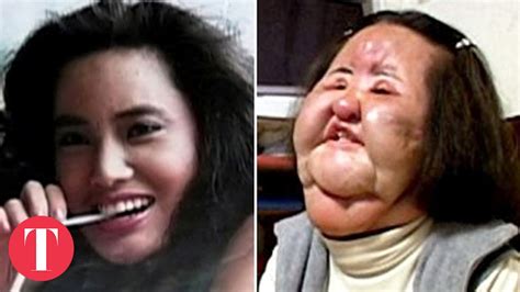 10 Cases of Plastic Surgery Gone Terribly Wrong - Beauty Treatments
