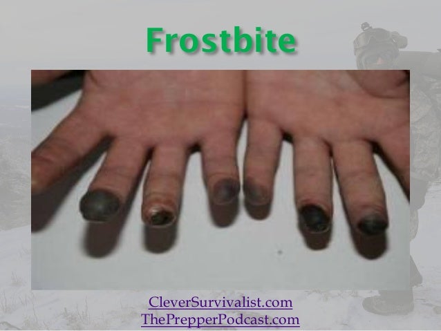 cold-weather-injuries-hypothermia-frostbite-frostnip-trenchfoot-immersion-foot-chilblains-first-aid-25-638.jpg